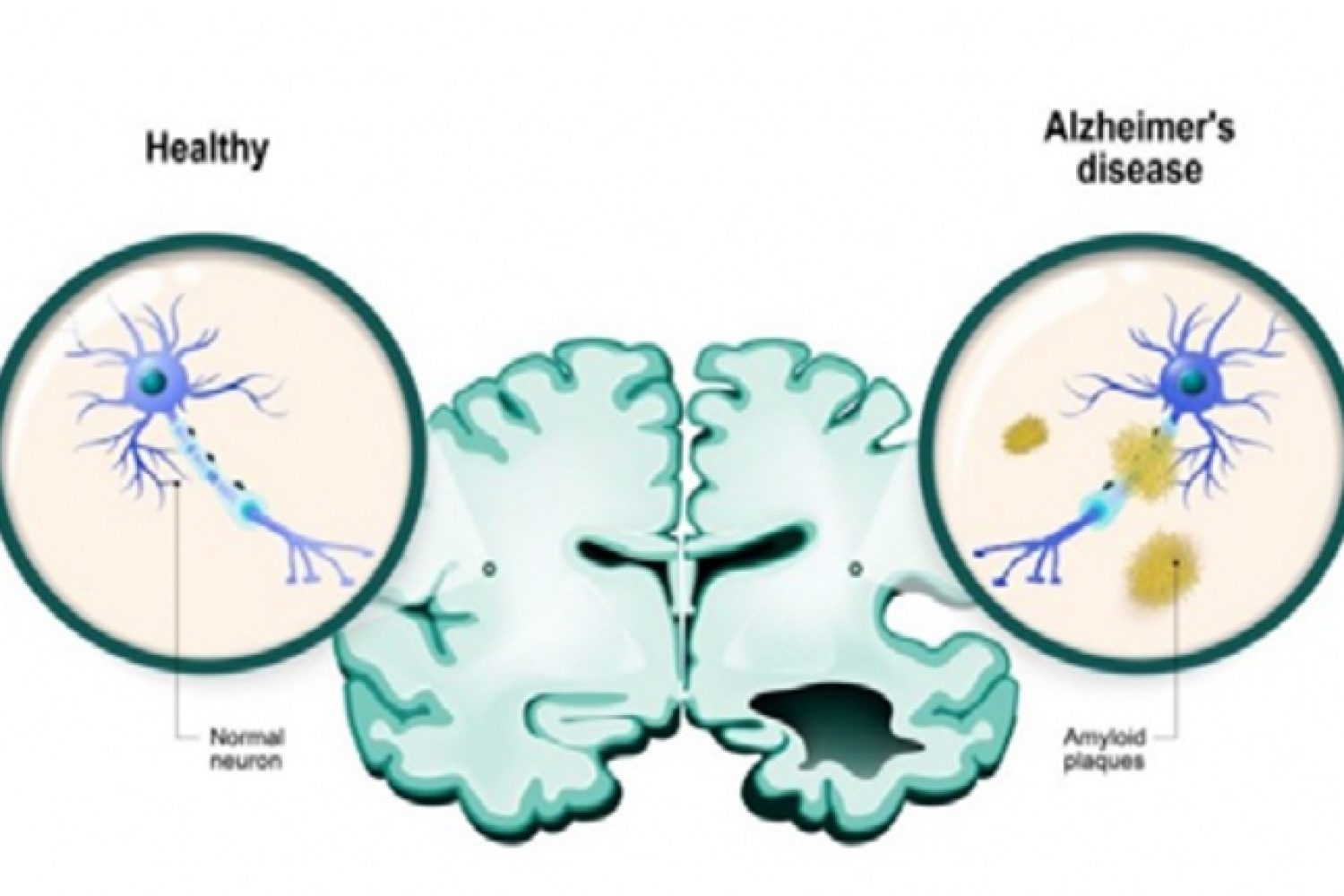 NEUROSTECH desarrolla un dispositivo implantable para el tratamiento de enfermedades neurodegenerativas