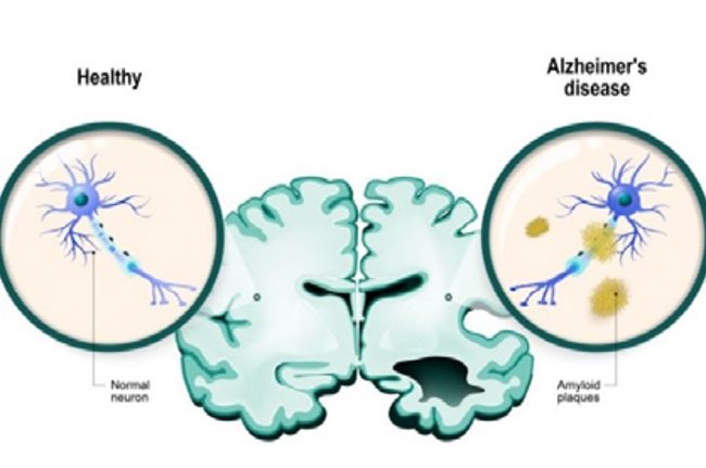NEUROSTECH desarrolla un dispositivo implantable para el tratamiento de enfermedades neurodegenerativas